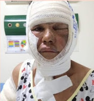 SUL DO PARÁ: MULHER É QUEIMADA PELO COMPANHEIRO NO DISTRITO DO NEREU, EM SÃO FÉLIX DO XINGU
