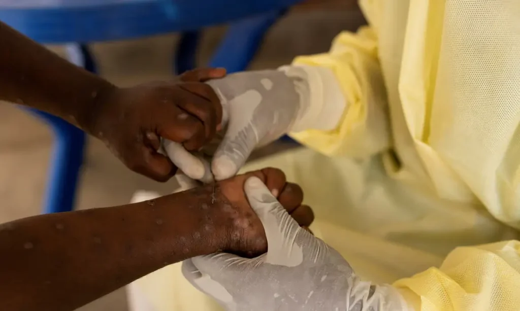 SAÚDE NEGOCIA COMPRA DE 25 MIL DOSES DE VACINA CONTRA MPOX