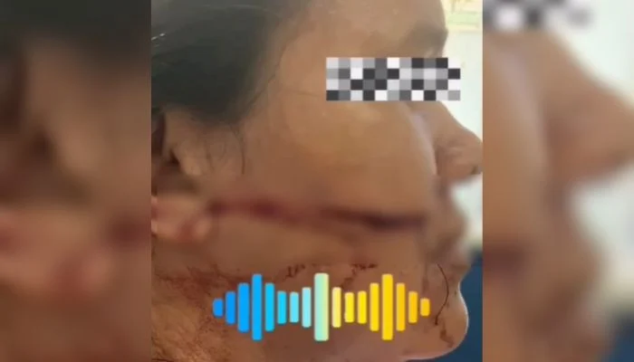 MULHER SOFRE CORTE NO ROSTO APÓS SER ATINGIDA POR LINHA COM CEROL EM CAPANEMA